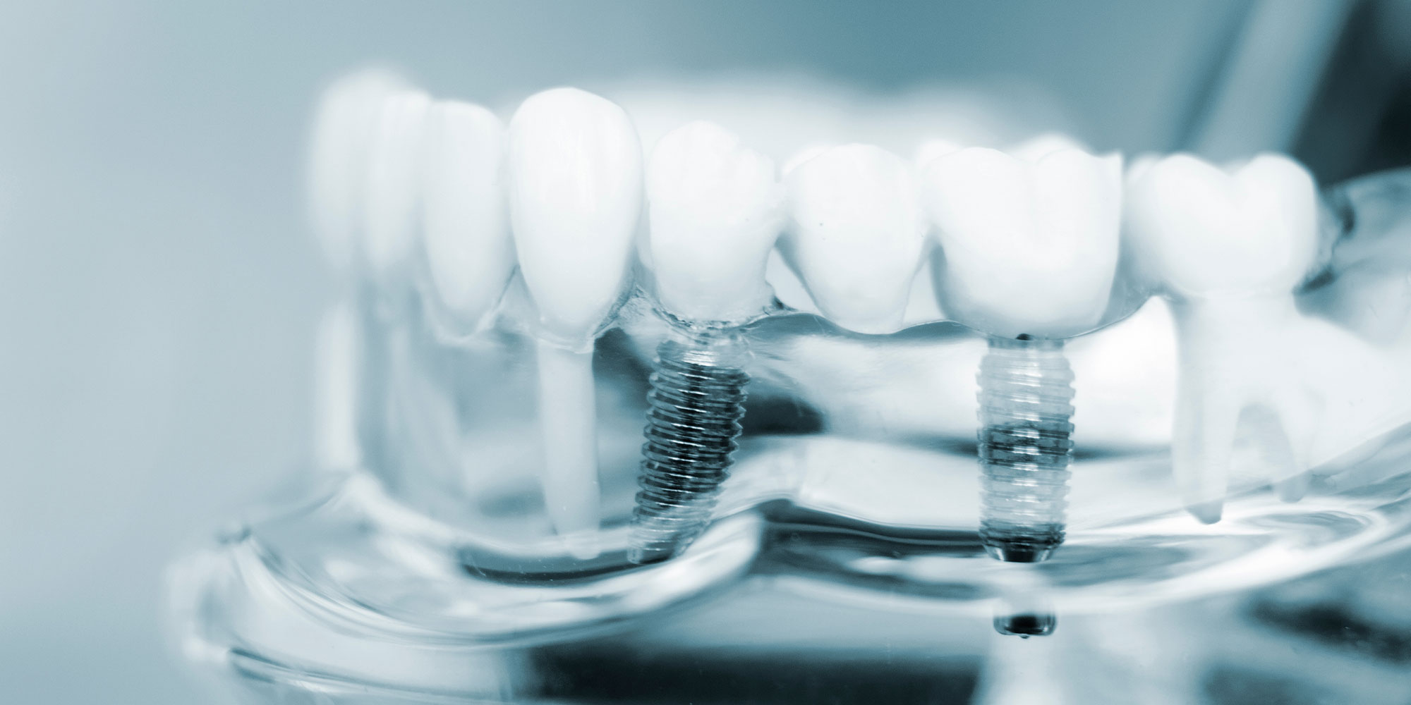 dental implant model