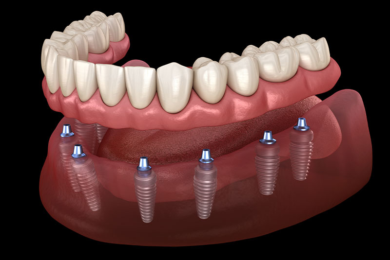 implant supported denture